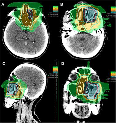 Particle Beam Radiation Therapy for Adenoid Cystic Carcinoma of the Nasal Cavity and Paranasal Sinuses